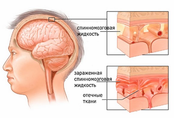 Будьте бдительны - Менингит: сам не спит и другим не велит